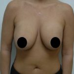 Breast Augmentation & Lift Before & After Patient #1405