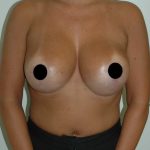 Breast Augmentation & Lift Before & After Patient #1405
