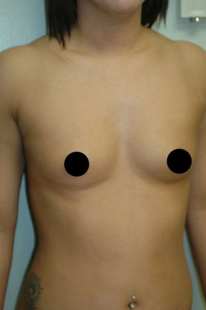 Breast Augmentation & Lift Before & After Patient #1415