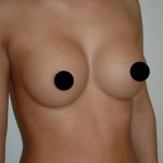 Breast Augmentation & Lift Before & After Patient #1415