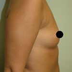 Breast Augmentation & Lift Before & After Patient #1413