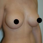 Breast Augmentation & Lift Before & After Patient #1412
