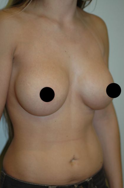 Breast Augmentation & Lift Before & After Patient #1412