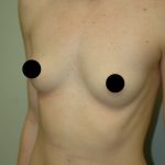 Breast Augmentation & Lift Before & After Patient #1411