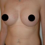 Breast Augmentation & Lift Before & After Patient #1411