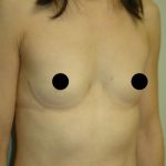 Breast Augmentation & Lift Before & After Patient #1410