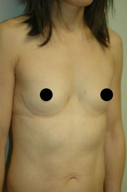 Breast Augmentation & Lift Before & After Patient #1410