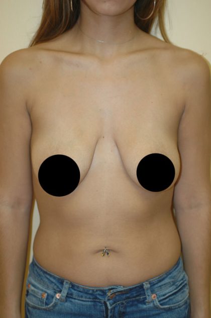 Breast Augmentation & Lift Before & After Patient #1409