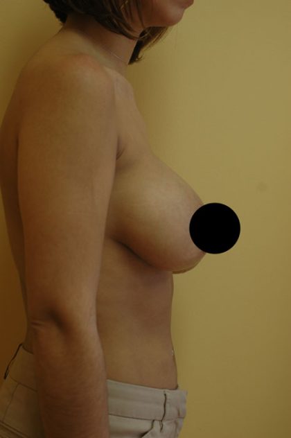 Breast Augmentation & Lift Before & After Patient #1409