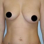 Breast Augmentation & Lift Before & After Patient #1408