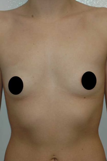 Breast Augmentation & Lift Before & After Patient #1407