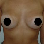 Breast Augmentation & Lift Before & After Patient #1407