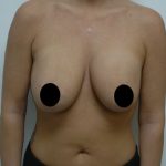 Breast Lift Before & After Patient #1463