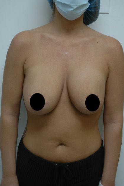 Breast Lift Before & After Patient #1463