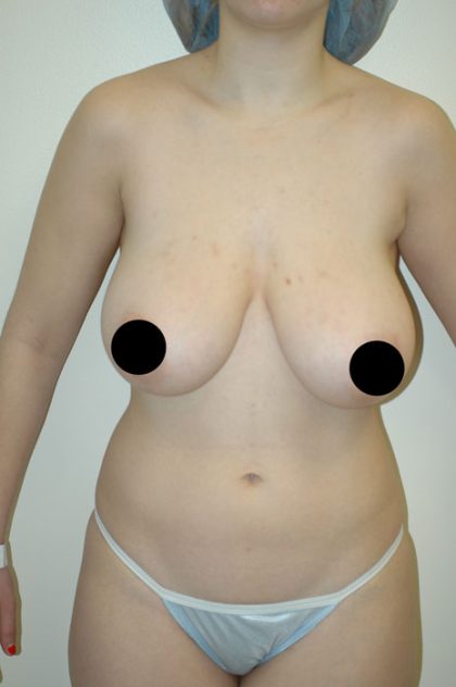 Breast Lift Before & After Patient #1464