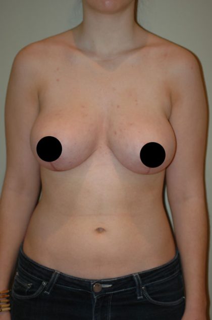 Breast Lift Before & After Patient #1464