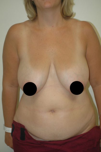 Breast Lift Before & After Patient #1465