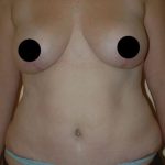 Breast Lift Before & After Patient #1465