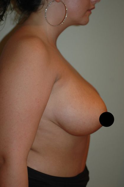 Breast Lift Before & After Patient #1466