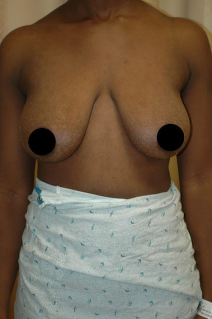 Breast Lift Before & After Patient #1467