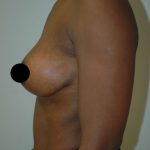 Breast Lift Before & After Patient #1467