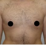 Gynecomastia Before & After Patient #1509