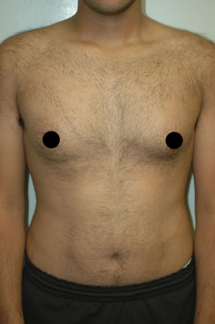 Gynecomastia Before & After Patient #1508