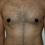 Gynecomastia Before & After Patient #1508