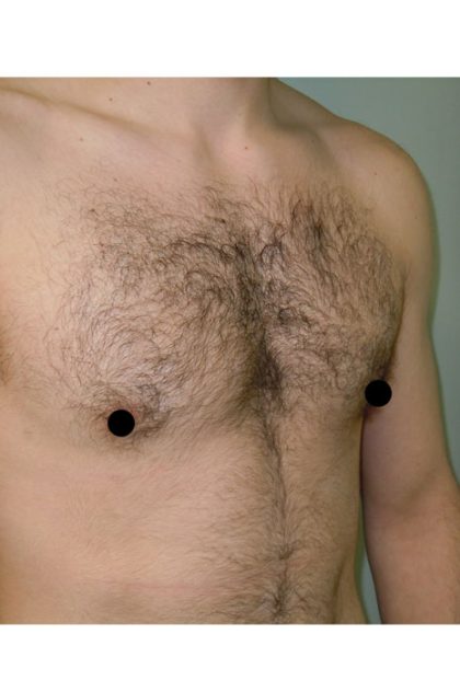 Gynecomastia Before & After Patient #1507