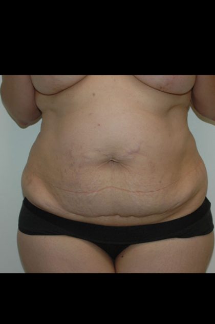 Liposuction Before & After Patient #1922