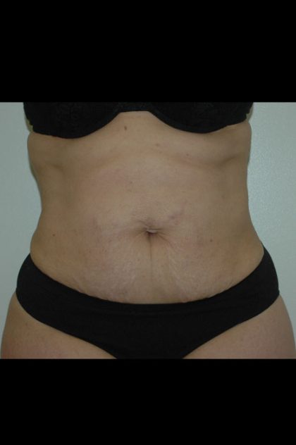 Liposuction Before & After Patient #1922