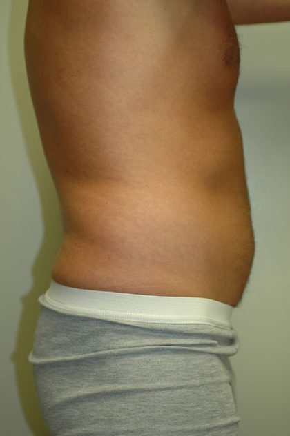 Liposuction Before & After Patient #1934