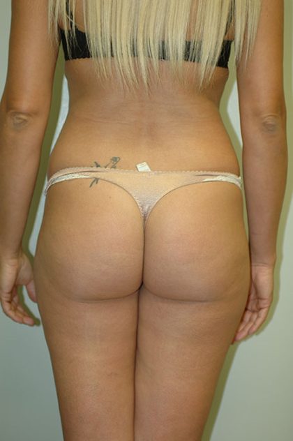 Liposuction Before & After Patient #1935