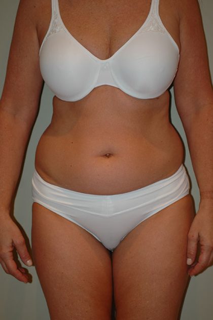 Liposuction Before & After Patient #1936