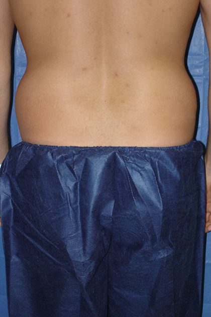 Liposuction Before & After Patient #1937