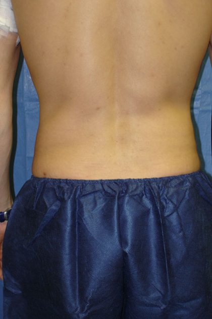 Liposuction Before & After Patient #1937