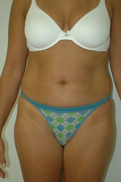 Liposuction Before & After Patient #1938