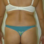 Liposuction Before & After Patient #1938