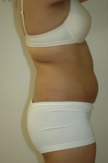 Liposuction Before & After Patient #1924