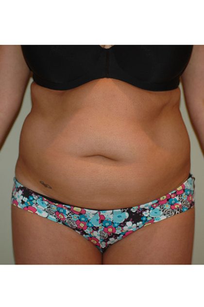 Liposuction Before & After Patient #1925