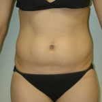 Liposuction Before & After Patient #1926