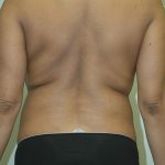 Liposuction Before & After Patient #1927