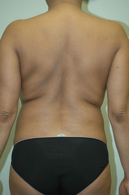 Liposuction Before & After Patient #1927