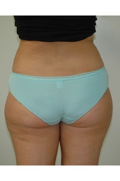 Liposuction Before & After Patient #1929
