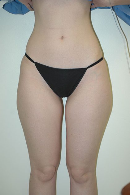 Liposuction Before & After Patient #1930