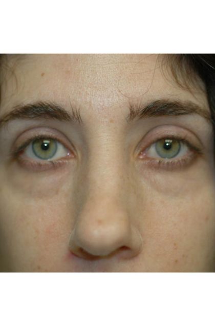 Blepharoplasty Before & After Patient #1702
