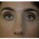 Blepharoplasty Before & After Patient #1702