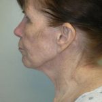 Facelift Before & After Patient #1709
