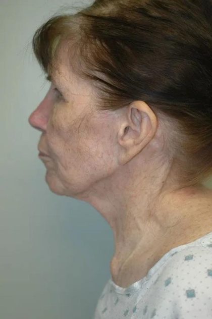 Facelift Before & After Patient #1709