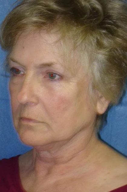 Facelift Before & After Patient #1710